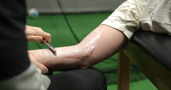 Recovering from Tommy John Surgery