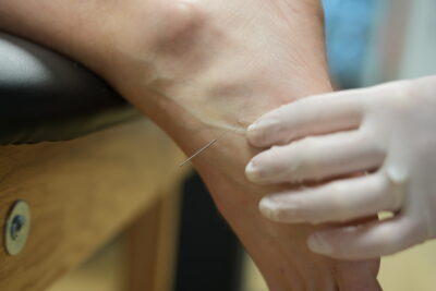 Dry Needling in Raleigh Cary and Surrounding Areas